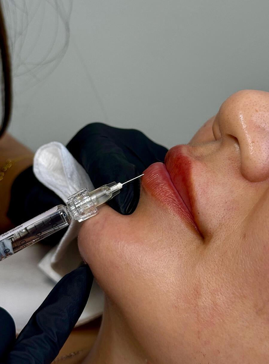 Lip filler appointment closeup