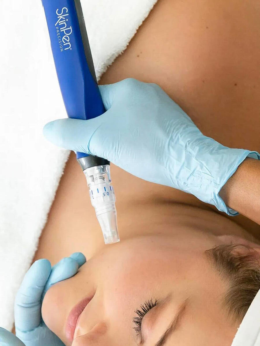 SkinPen microneedling treatment